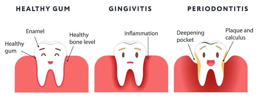 Gingivitis Stages Illustration