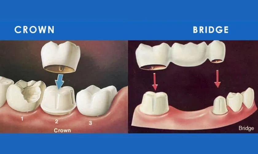 Dental bridges and crowns treatment illustration