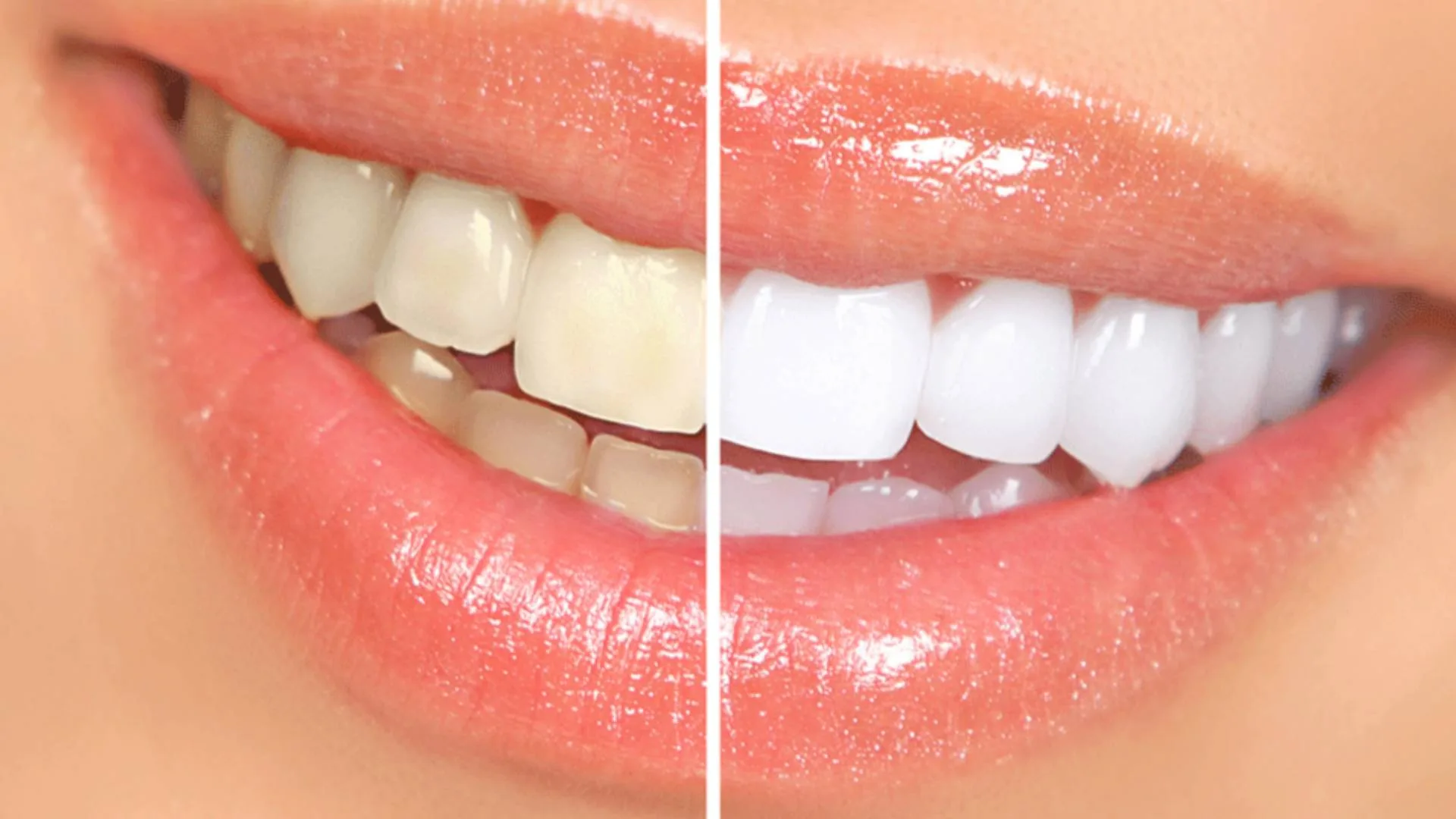 Professional teeth whitening treatment results