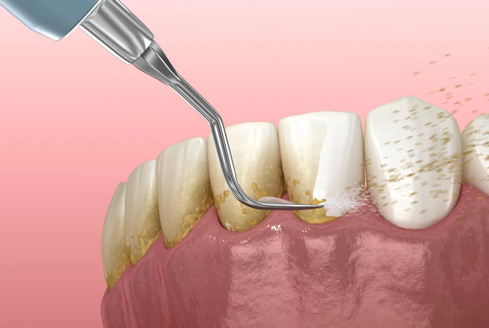 Teeth Scaling illustration