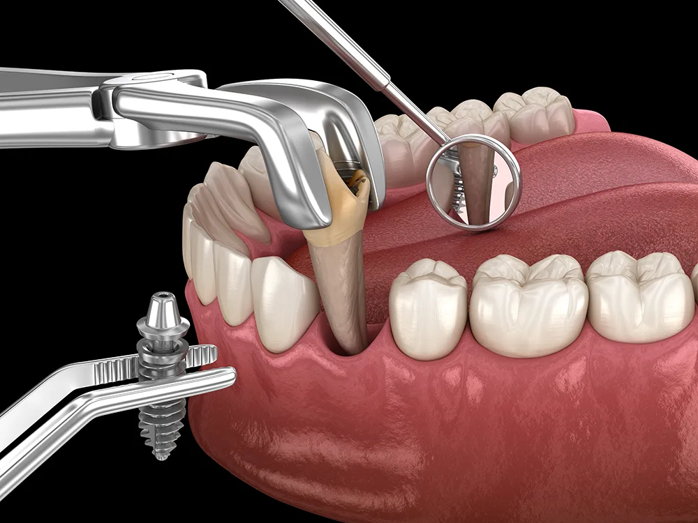 Tooth Extraction illustration