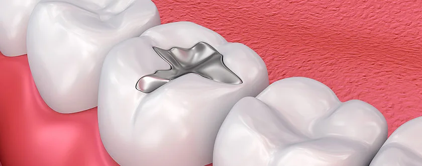 Teeth filling Illustration