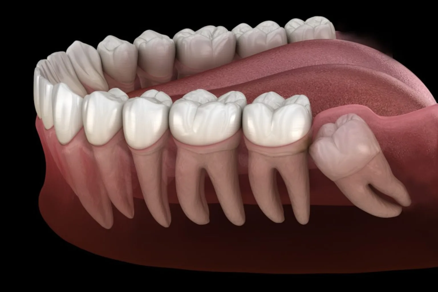Wisdom tooth extraction procedure illustration